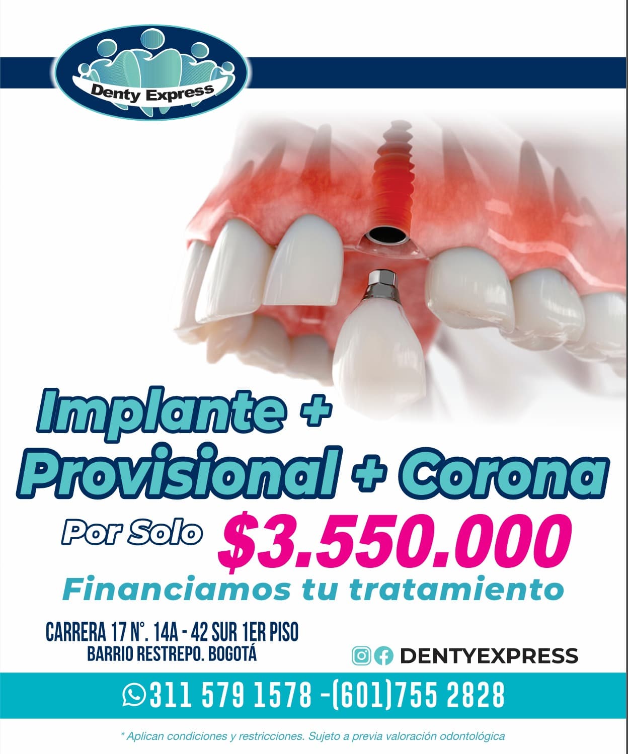 Promoción de implantes y coronas