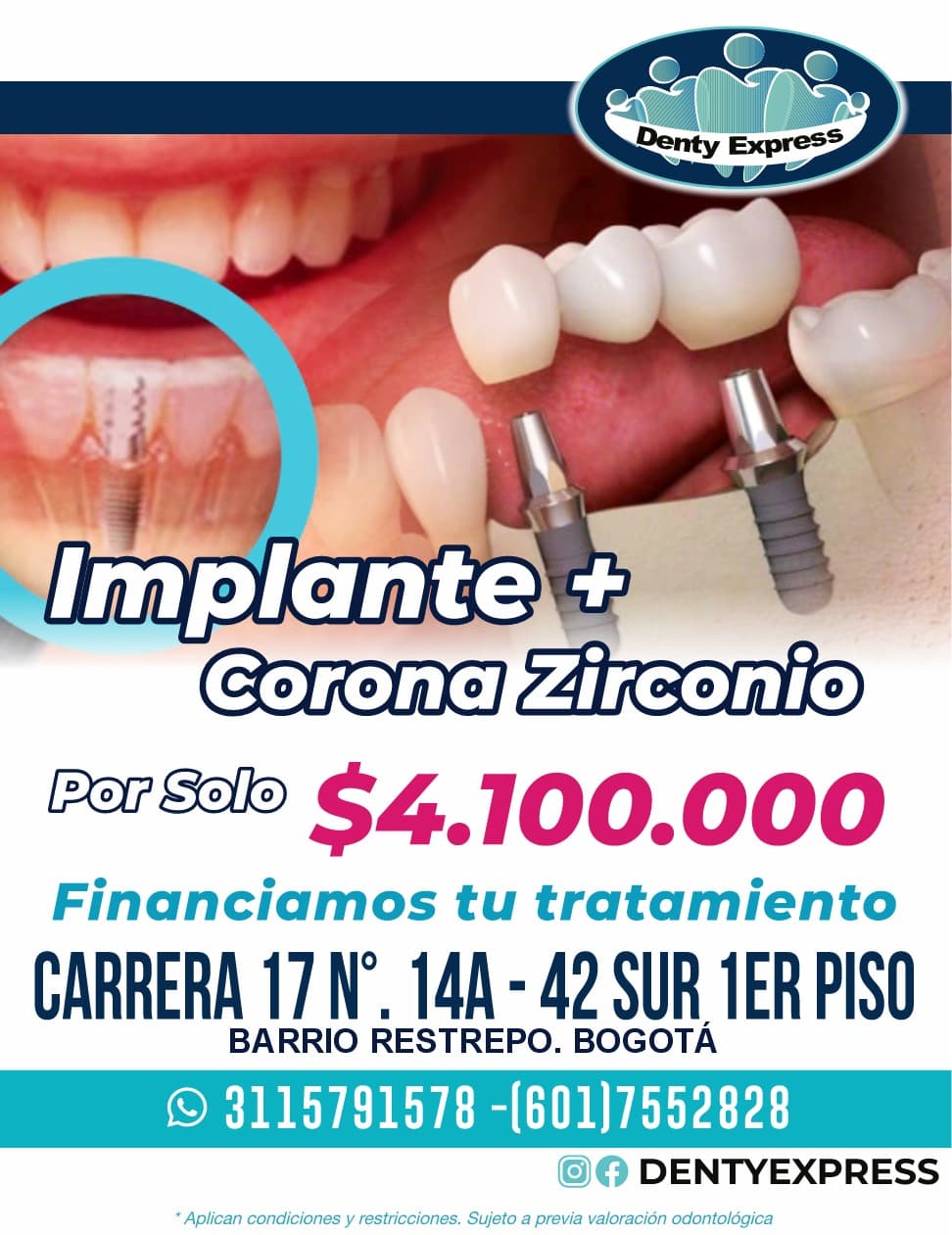 Promoción de implantes dentales