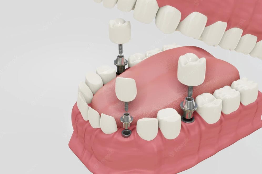 Implantes dentales