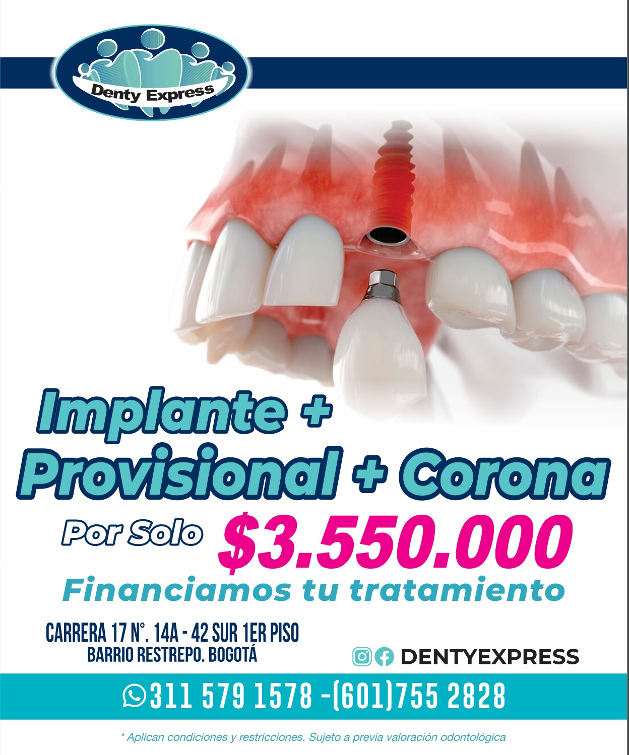 Promoción de implantes y coronas